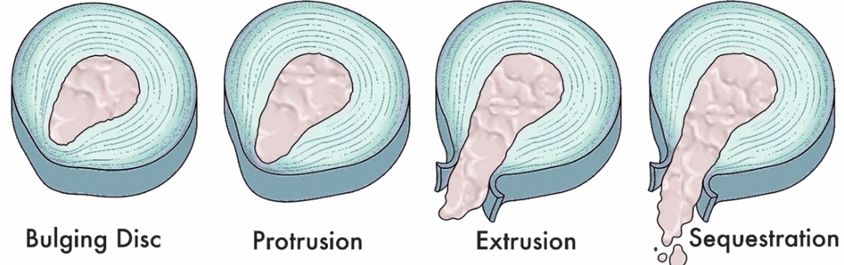 Diagram showing the four stages of disc herniation: bulging, protrusion, extrusion and sequestration